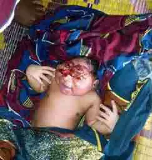 The Baby Born With Anencephaly In Benue State Is Dead (Photo)